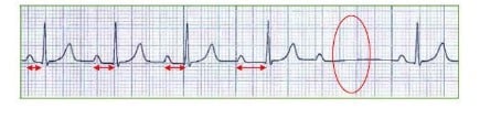 Patologías básicas en la conducción del impulso eléctrico cardíaco