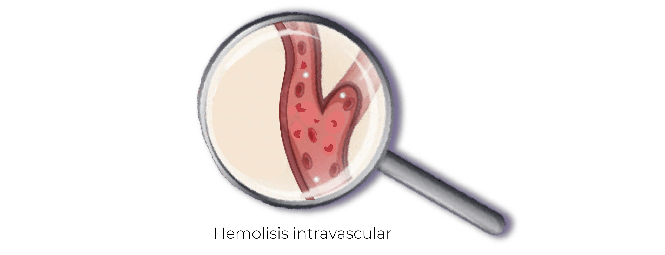Hemoliosis intravascular
