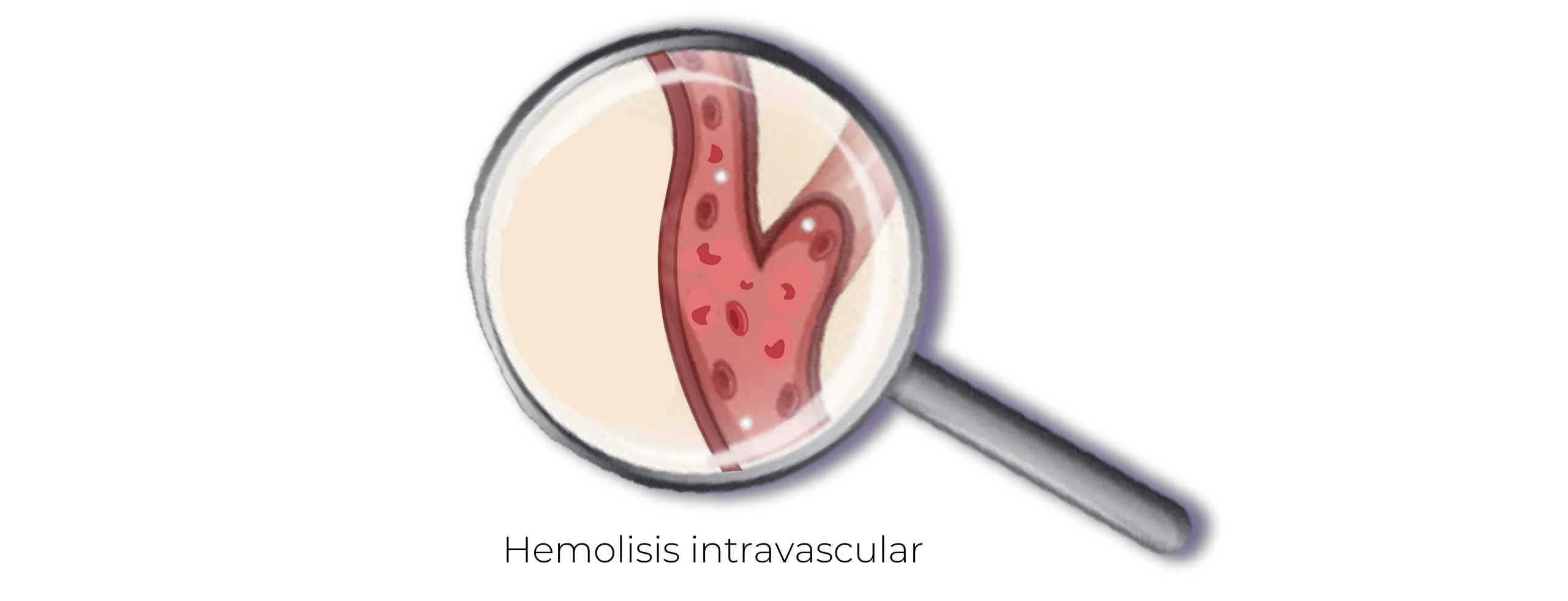 Hemoliosis intravascular